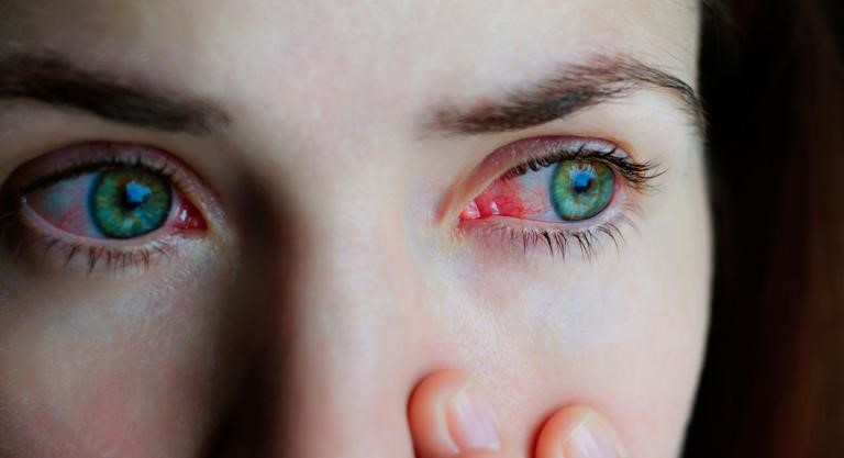¿Qué provoca las infecciones por lentes de contacto?